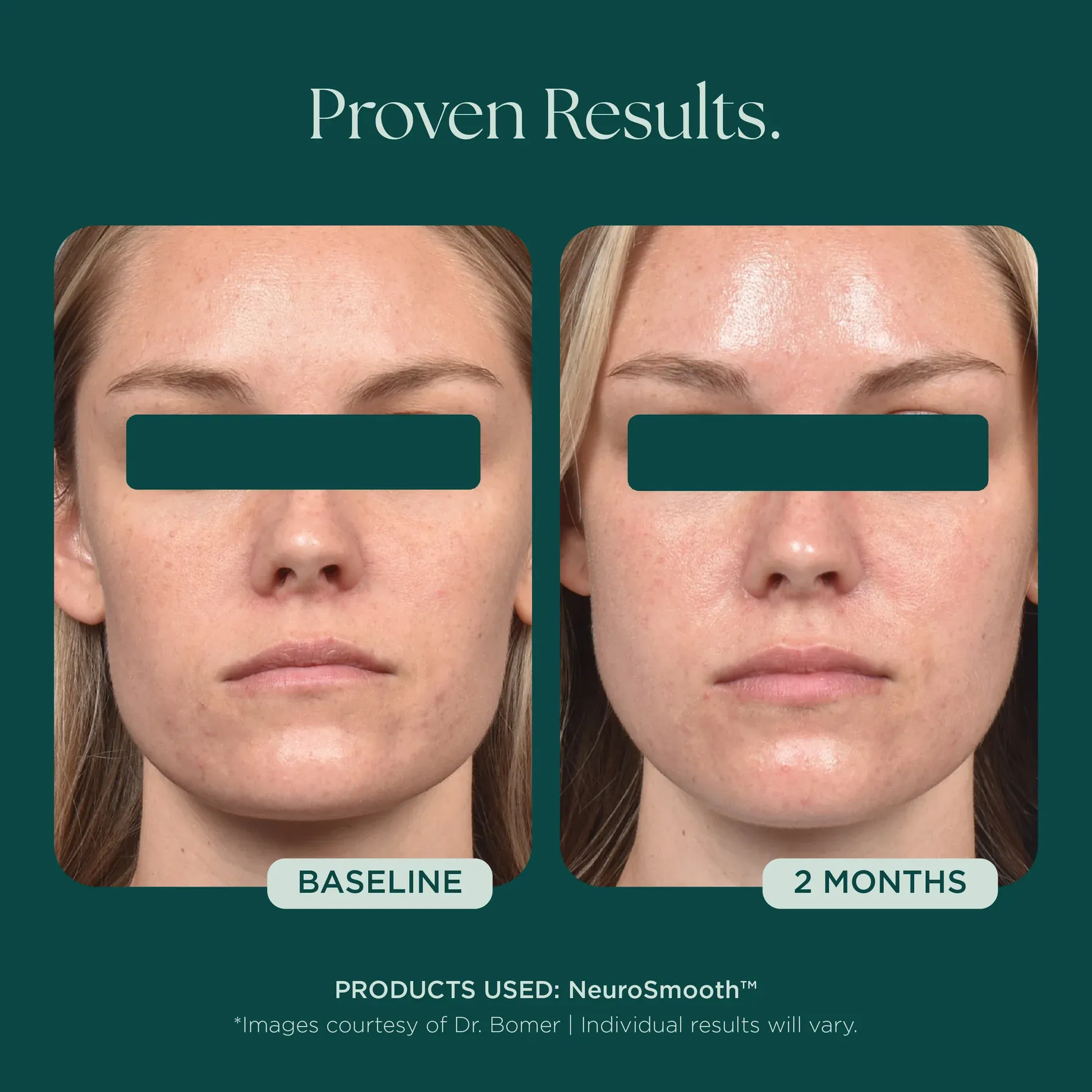 Facial results with NeuroSmooth™ treatment