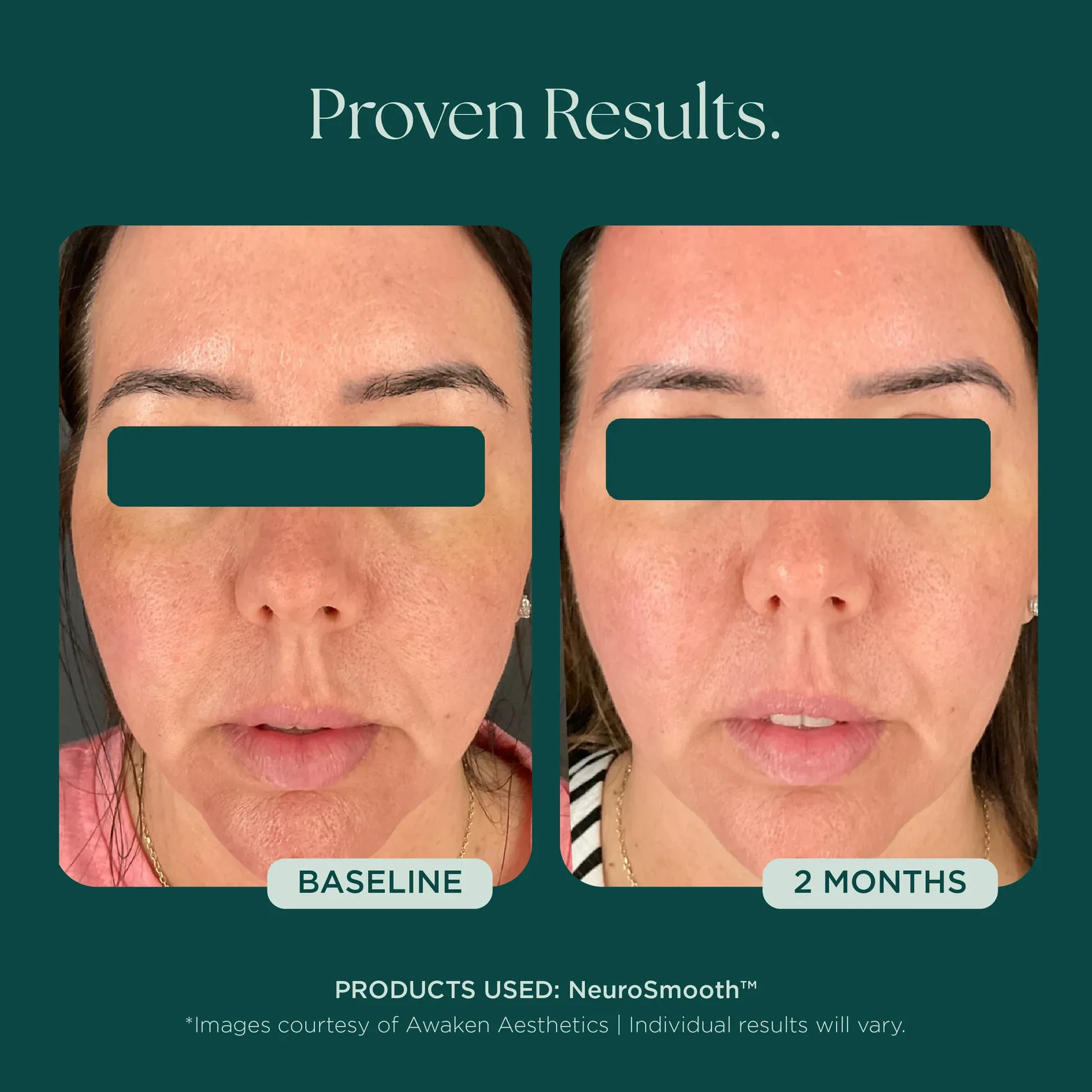 Facial improvement in two months