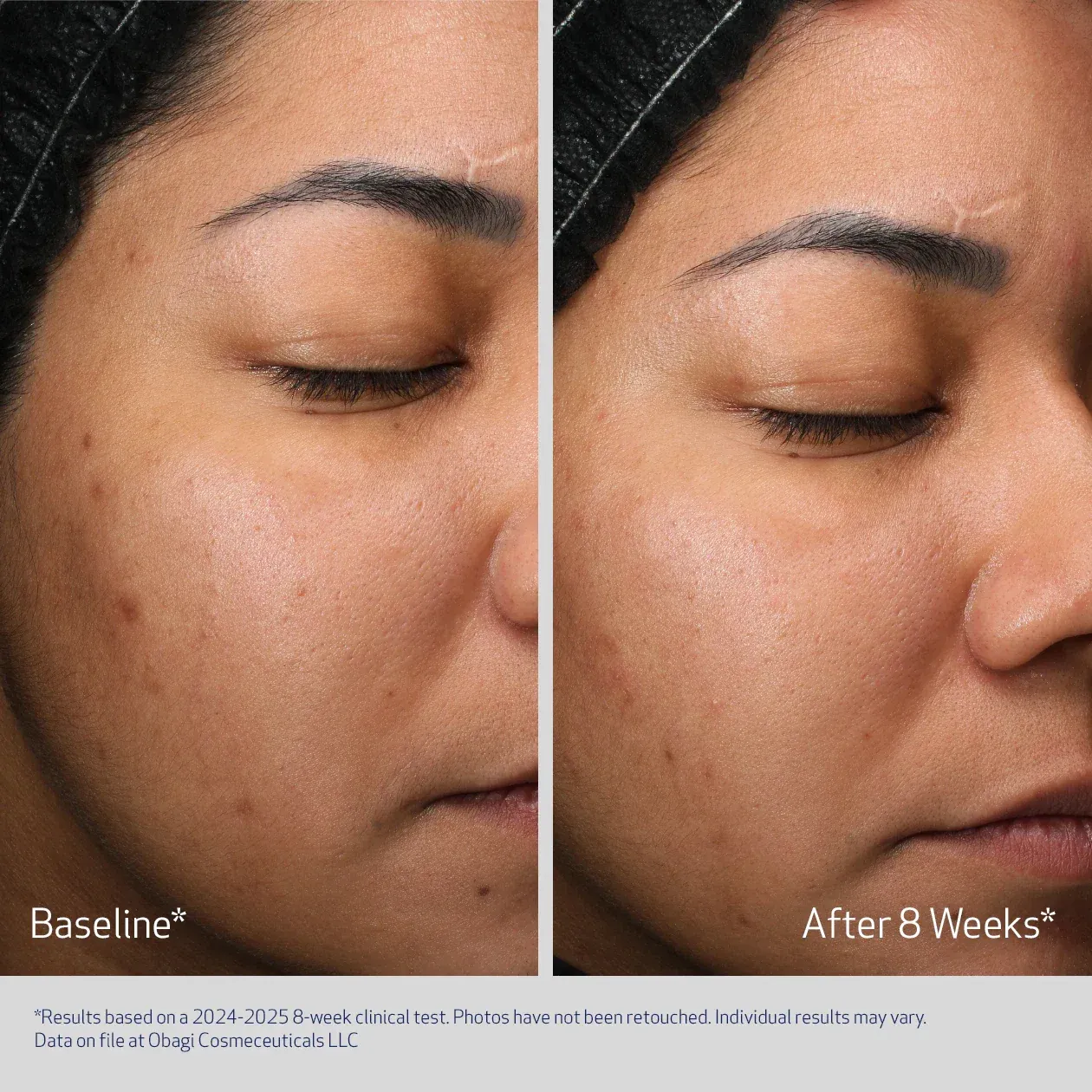 Facial skin improvement over eight weeks