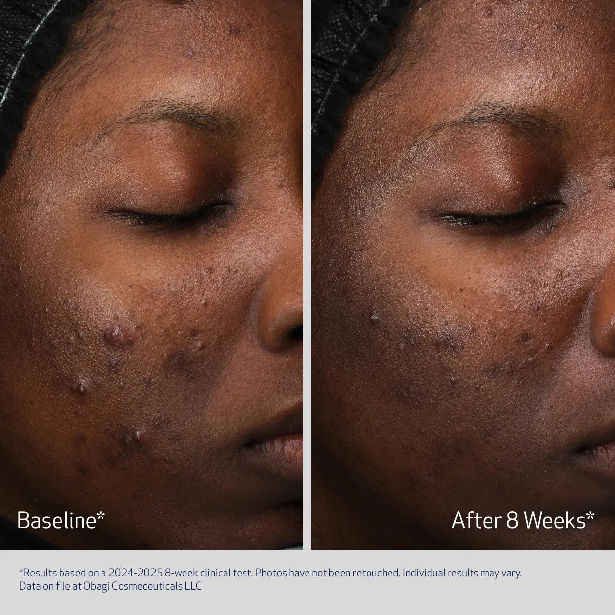 Skin improvement in eight weeks