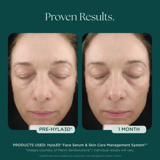 Skincare progress with Hyla3D serum
