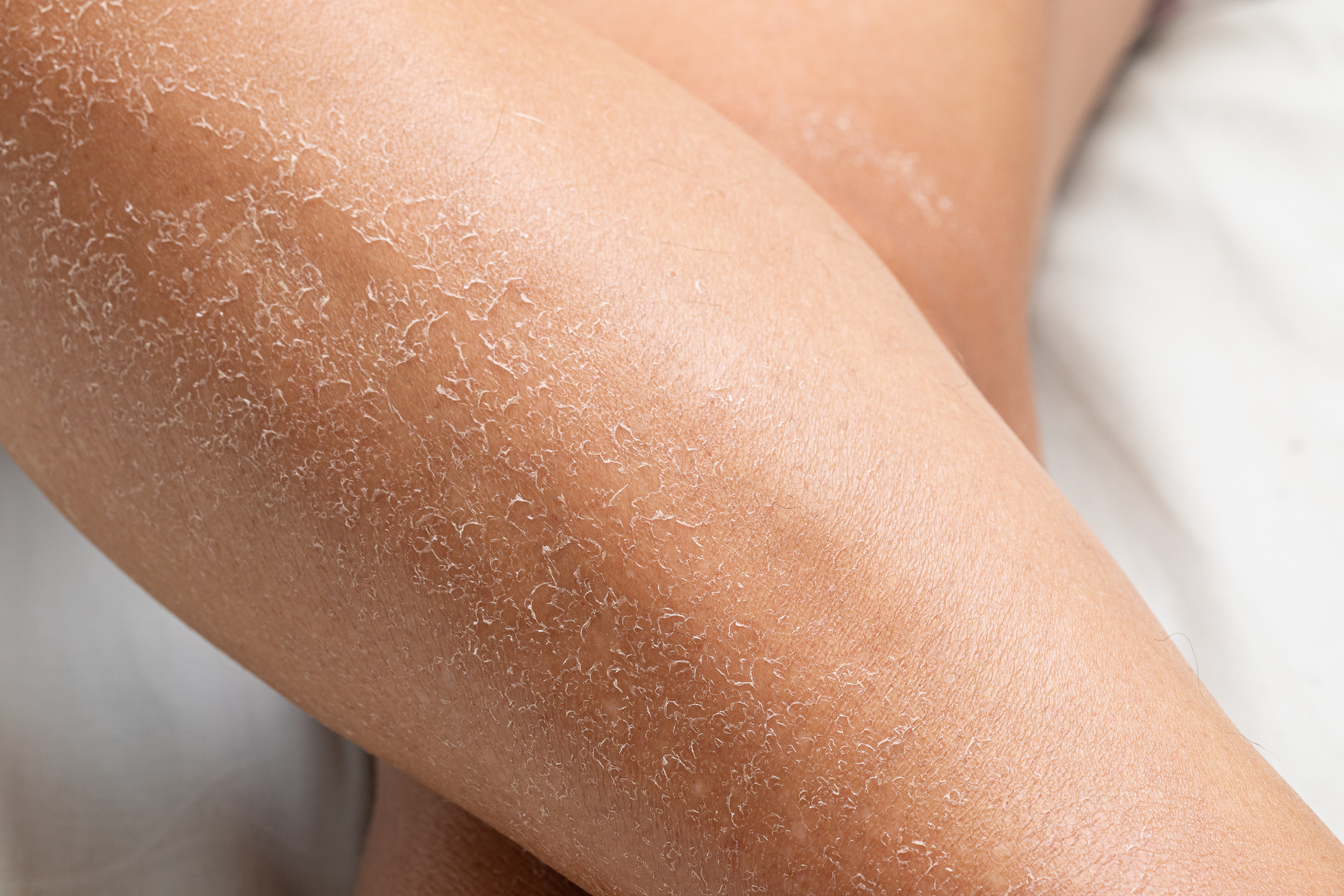 Macro of detail of dry skin of woman legs. Close up of dehydration due to the sun's rays without sun protection cream