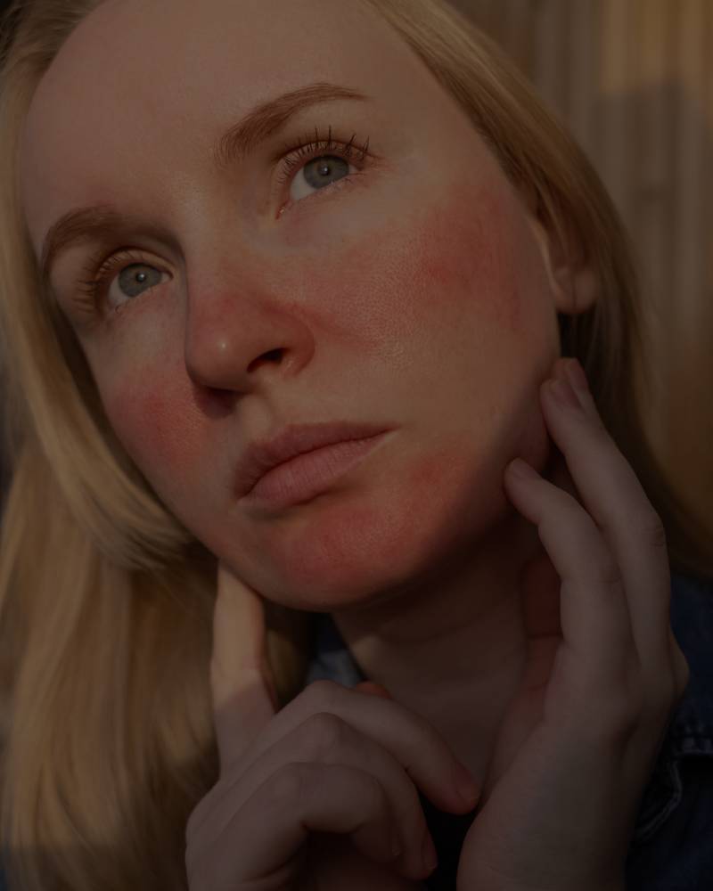 Skin With Sensitivity, Rosacea, Broken Capillaries, Couperose, and Redness Prone