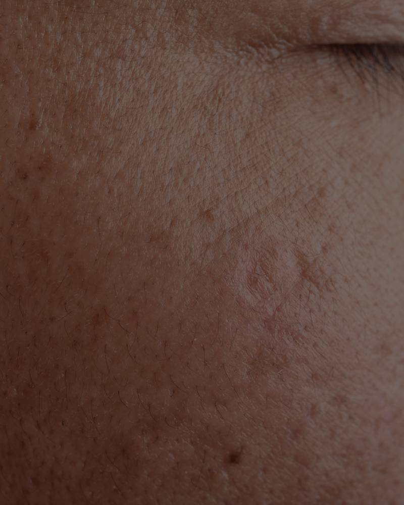 Skin That is Dehydrated With Loss of Volume
