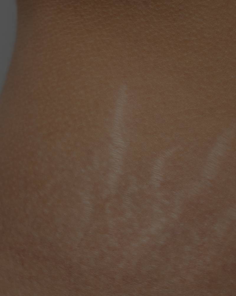 Visible Stretch Marks